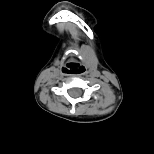 Chiari I with syrinx and skull base anomalies (Radiopaedia 89444-106412 Axial non-contrast 92).jpg