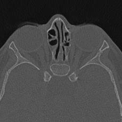 Choanal atresia (Radiopaedia 88525-105975 Axial bone window 82).jpg