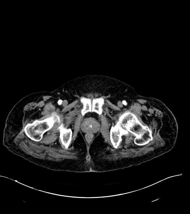 Cholangiocarcinoma with cerebral metastases (Radiopaedia 83519-98629 B 126).jpg