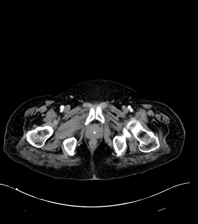 Cholangiocarcinoma with cerebral metastases (Radiopaedia 83519-98629 B 128).jpg