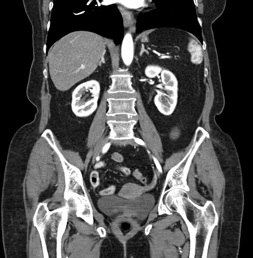 File:Cholecystoduodenal fistula due to calculous cholecystitis with gallstone migration (Radiopaedia 86875-103077 B 28).jpg