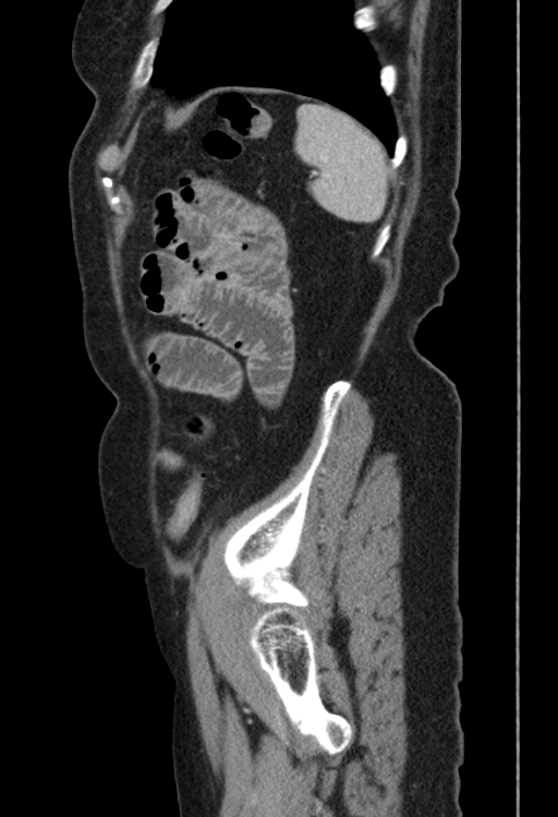 Cholecystoduodenal fistula due to calculous cholecystitis with gallstone migration (Radiopaedia 86875-103077 F 8).jpg