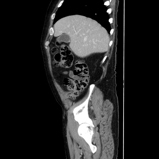 Choledocholiathiasis with normal caliber common bile duct (Radiopaedia 75368-86632 D 41).jpg
