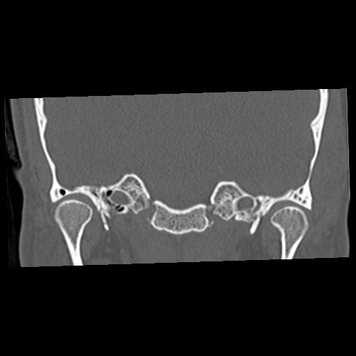 Cholesteatoma (Radiopaedia 84960-100474 Coronal bone window 24).jpg