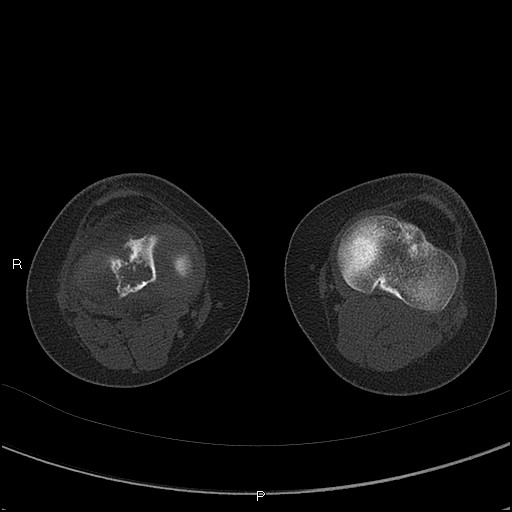 File:Chondroblastoma (Radiopaedia 62721-71030 Axial bone window 42).jpg