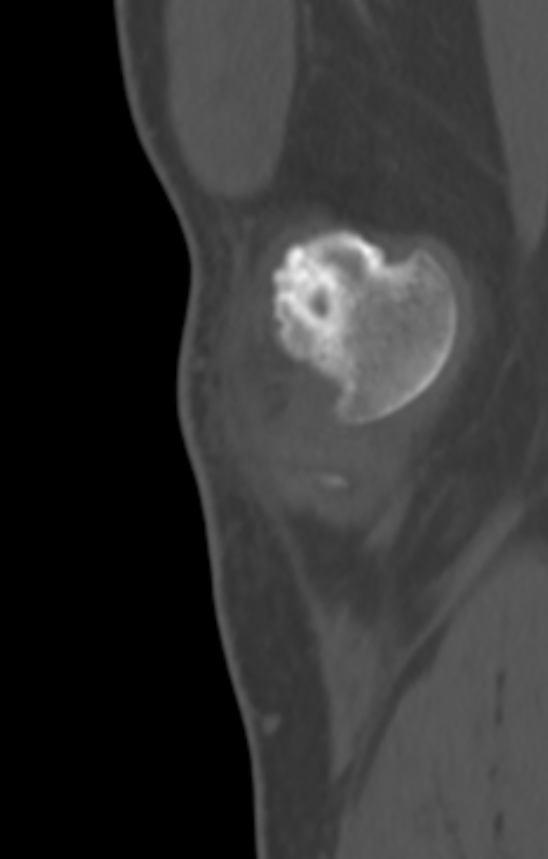 Chondrocalcinosis (Radiopaedia 82862-97173 Sagittal bone window 3).jpg