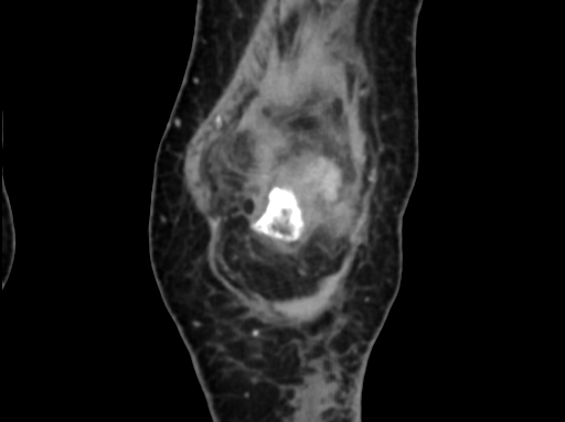 Chondrosarcoma - femur (Radiopaedia 64187-72954 C 12).jpg