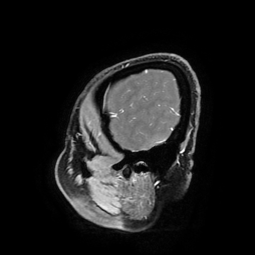 Chordoid glioma of third ventricle (Radiopaedia 91612-109340 F 181).jpg