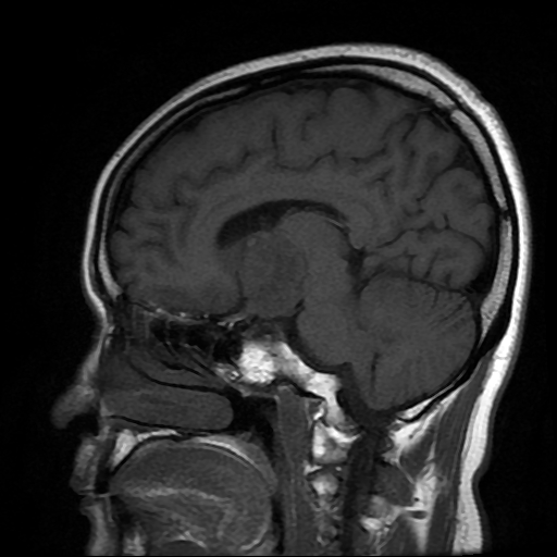 File:Chordoid glioma of third ventricle (Radiopaedia 91612-109340 Sagittal T1 11).jpg