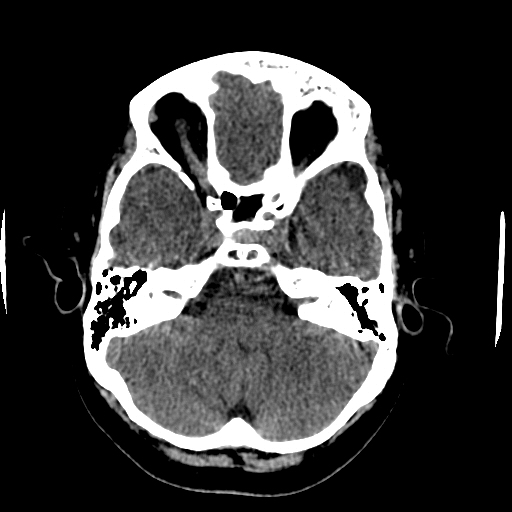 Choroid plexus xanthogranulomas (Radiopaedia 51621-57408 Axial non-contrast 23).jpg