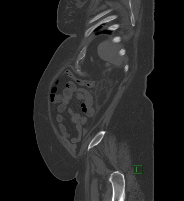 Chromophobe renal cell carcinoma (Radiopaedia 84239-99519 Sagittal bone window 14).jpg