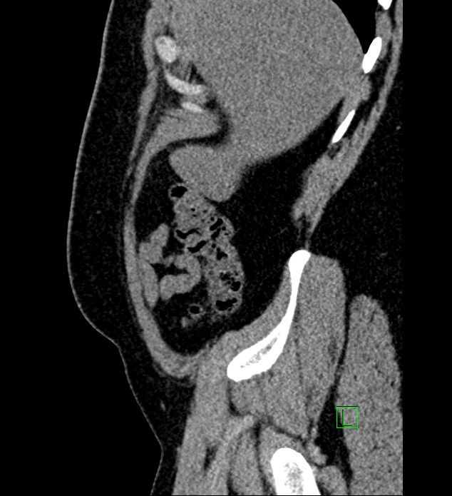 Chromophobe renal cell carcinoma (Radiopaedia 84286-99573 C 164).jpg