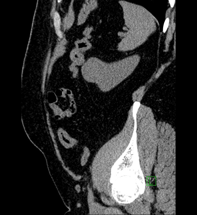 Chromophobe renal cell carcinoma (Radiopaedia 84286-99573 C 33).jpg
