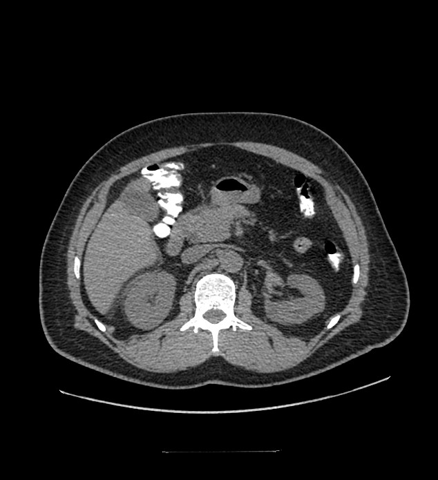 Chromophobe renal cell carcinoma (Radiopaedia 84337-99644 Axial non-contrast 35).jpg
