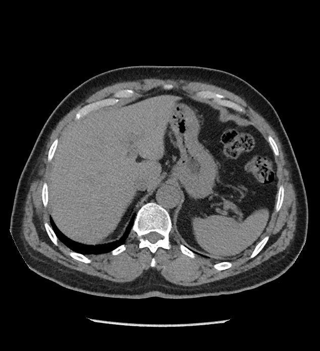 Chromophobe renal cell carcinoma (Radiopaedia 86879-103083 Axial non-contrast 10).jpg