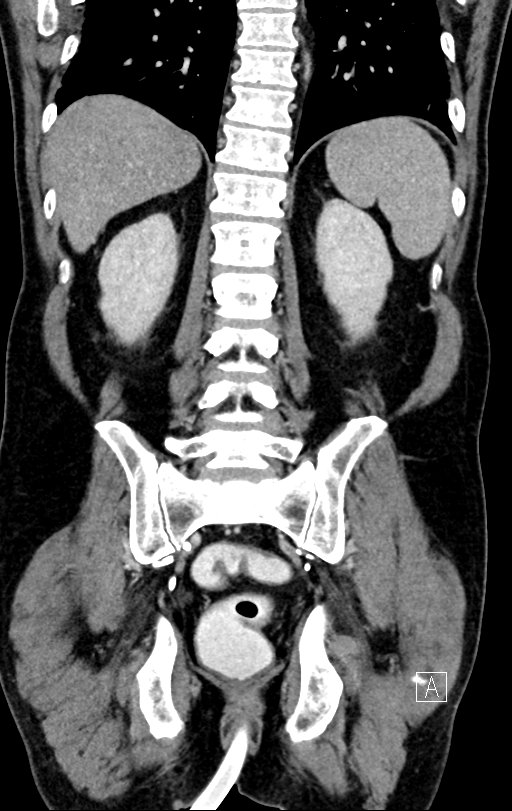 Chronic appendicitis complicated by appendicular abscess, pylephlebitis and liver abscess (Radiopaedia 54483-60700 C 61).jpg