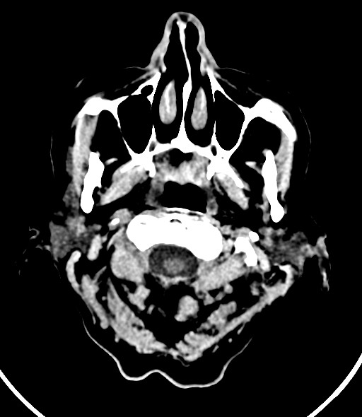 Chronic bilateral subdural hygroma (Radiopaedia 85801-101623 Axial non-contrast 60).jpg