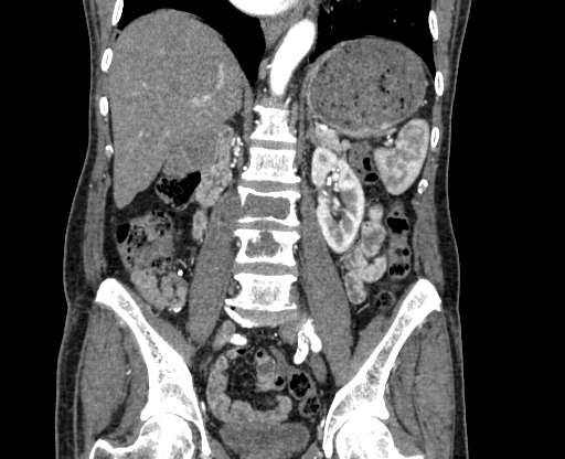 Chronic contained rupture of abdominal aortic aneurysm with extensive erosion of the vertebral bodies (Radiopaedia 55450-61901 D 45).jpg