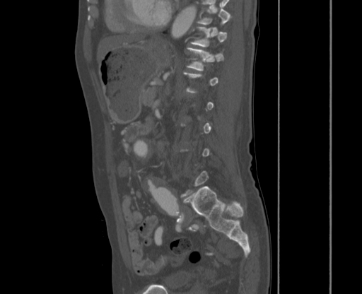 File:Chronic contained rupture of abdominal aortic aneurysm with extensive erosion of the vertebral bodies (Radiopaedia 55450-61901 Sagittal bone window 40).jpg