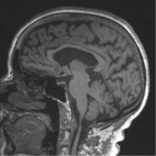 Chronic hypertensive encephalopathy (Radiopaedia 39993-42482 Sagittal T1 51).png