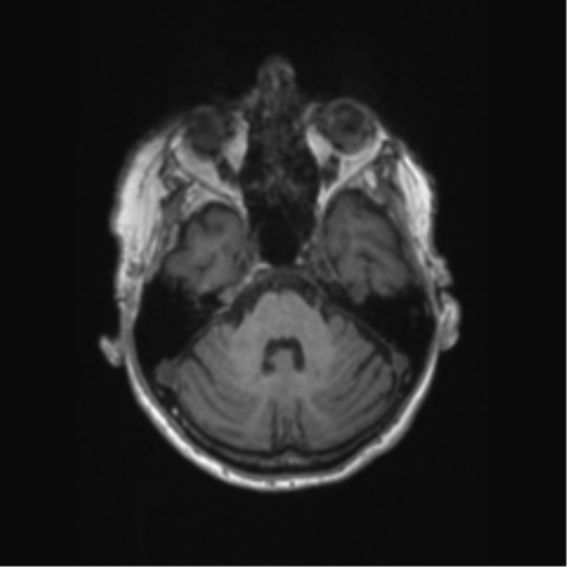 Chronic hypertensive encephalopathy (Radiopaedia 72844-83495 Axial T1 54).png