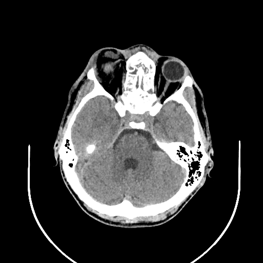 Chronic invasive fungal sinusitis (Radiopaedia 50342-55710 Axial non-contrast 53).jpg