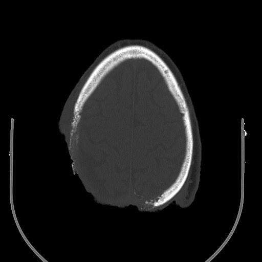 Chronic osteomyelitis - calvarial (severe) (Radiopaedia 69668-79616 Axial bone window 62).jpg