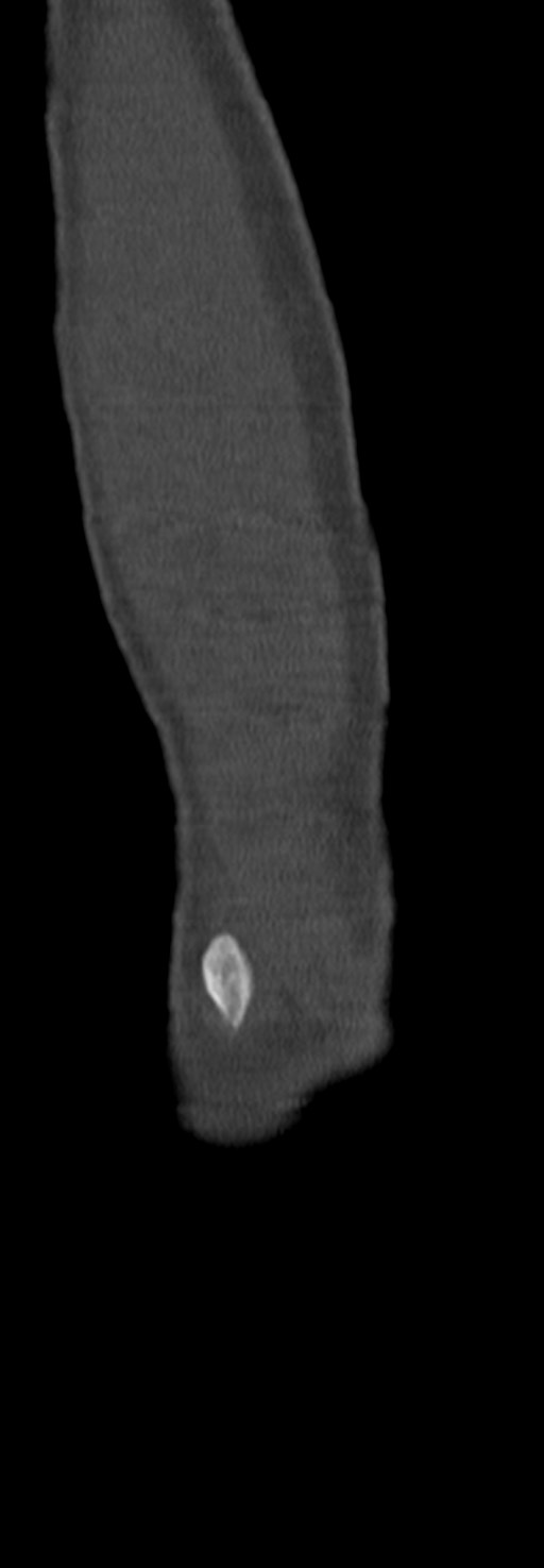 Chronic osteomyelitis of the distal humerus (Radiopaedia 78351-90971 Sagittal bone window 66).jpg