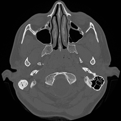 File:Chronic otomastoiditis (Radiopaedia 27138-27309 Axial bone window 2).jpg