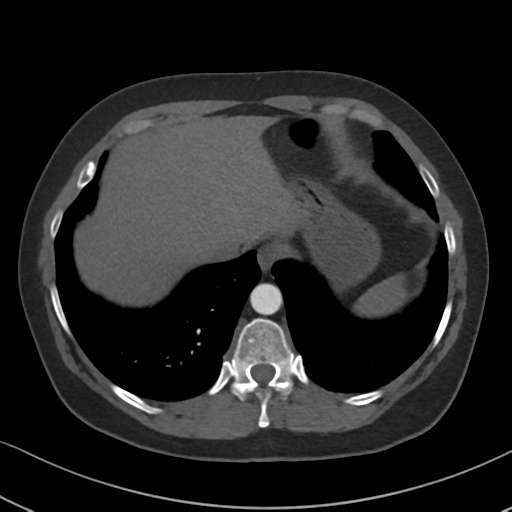 Chronic pulmonary embolus (Radiopaedia 39129-41341 Axial C+ CTPA 84).png