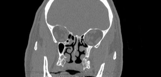 Chronic sphenoidal sinusitis (Radiopaedia 62030-70122 Coronal bone window 79).jpg