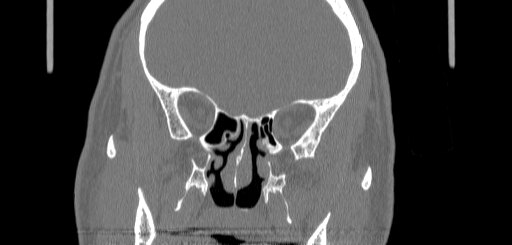 Chronic sphenoidal sinusitis (Radiopaedia 62030-70122 Coronal bone window 90).jpg