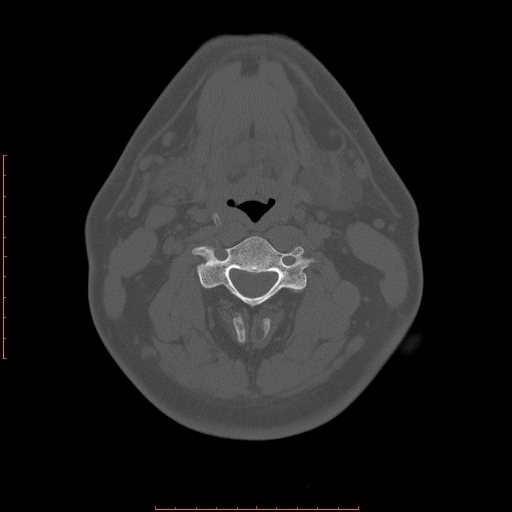 Chronic submandibular sialolithiasis (Radiopaedia 69817-79814 Axial bone window 90).jpg