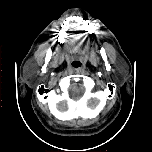 File:Chronic submandibular sialolithiasis (Radiopaedia 69817-79814 Axial non-contrast 49).jpg