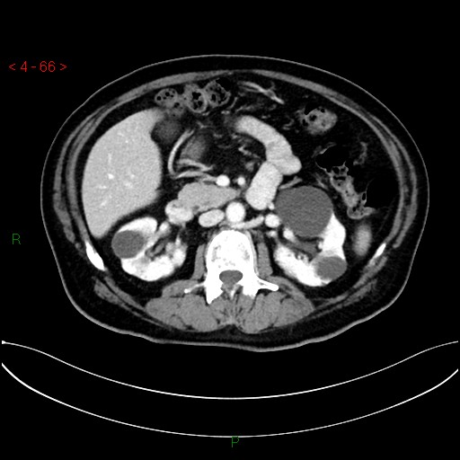 File:Circumaortic left renal vein and doubled left renal arteries (Radiopaedia 52268-58158 B 26).jpg
