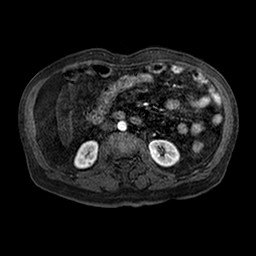 Cirrhosis and hepatocellular carcinoma in the setting of hemochromatosis (Radiopaedia 75394-86594 Axial T1 C+ fat sat 97).jpg