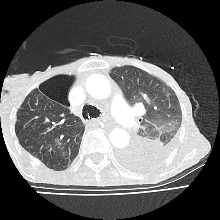 Clagett thoracotomy with bronchopleural fistula (Radiopaedia 29192-29587 Axial lung window 18).jpg