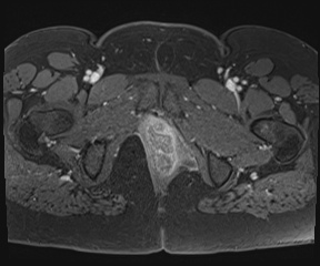 File:Class II Mullerian duct anomaly- unicornuate uterus with rudimentary horn and non-communicating cavity (Radiopaedia 39441-41755 Axial T1 fat sat 131).jpg
