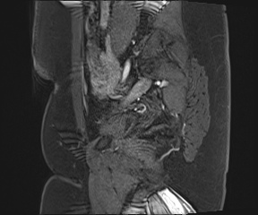 File:Class II Mullerian duct anomaly- unicornuate uterus with rudimentary horn and non-communicating cavity (Radiopaedia 39441-41755 G 18).jpg