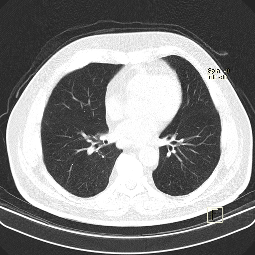 File:Classic complicated silicosis (Radiopaedia 49720-54961 Axial lung window 34).jpg