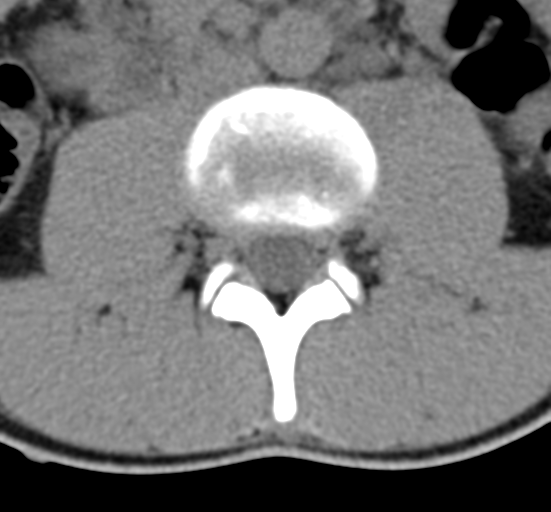File:Clear cell meningoma - lumbar spine (Radiopaedia 60116-67691 Axial non-contrast 33).png