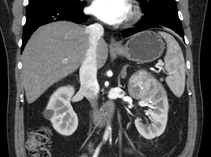 File:Clear cell renal cell carcinoma (Radiopaedia 61449-69393 C 14).jpg