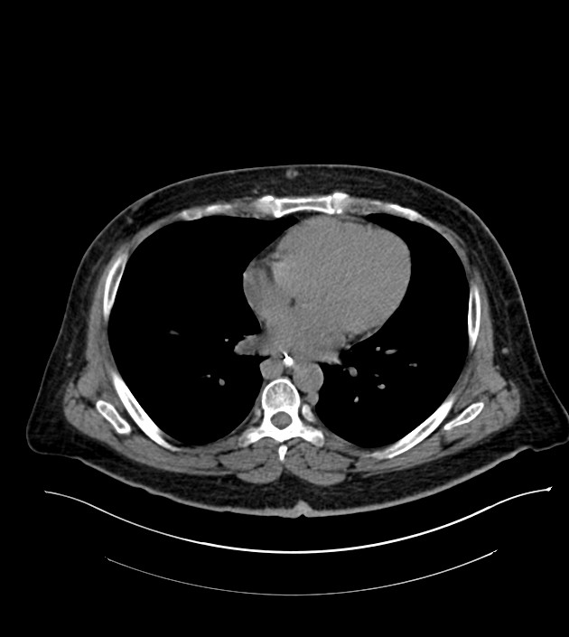 Closed-loop small bowel obstruction-internal hernia (Radiopaedia 78439-91096 Axial non-contrast 5).jpg