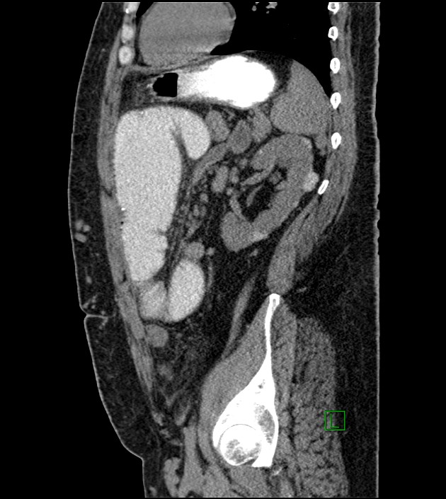 Closed-loop small bowel obstruction-internal hernia (Radiopaedia 78439-91096 C 51).jpg