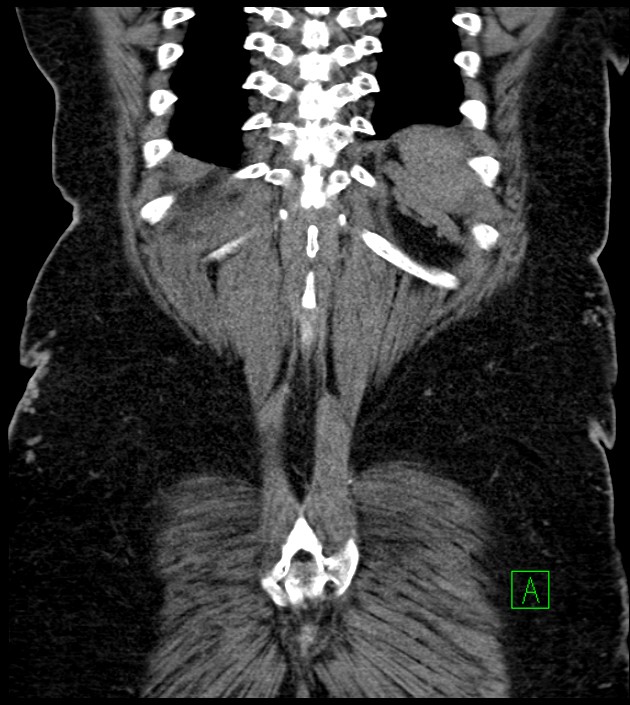 Closed-loop small bowel obstruction-internal hernia (Radiopaedia 78439-91096 Coronal non-contrast 88).jpg