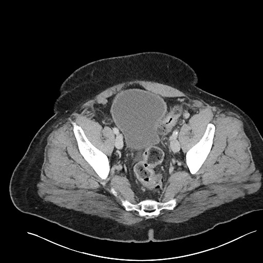 File:Closed loop obstruction - internal hernia into nephrectomy bed (Radiopaedia 59867-67320 A 122).jpg
