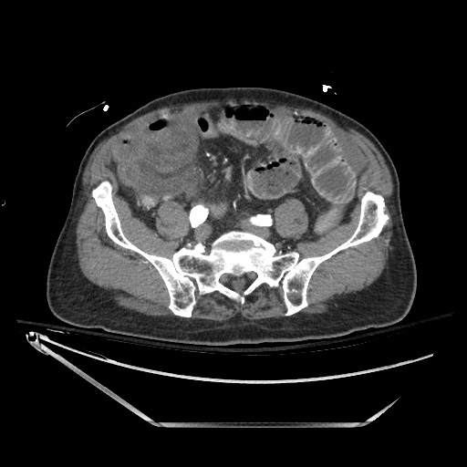 File:Closed loop obstruction due to adhesive band, resulting in small bowel ischemia and resection (Radiopaedia 83835-99023 B 108).jpg