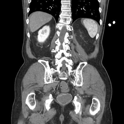 Closed loop obstruction due to adhesive band, resulting in small bowel ischemia and resection (Radiopaedia 83835-99023 C 95).jpg