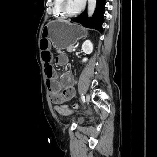 File:Closed loop obstruction due to adhesive band, resulting in small bowel ischemia and resection (Radiopaedia 83835-99023 F 117).jpg