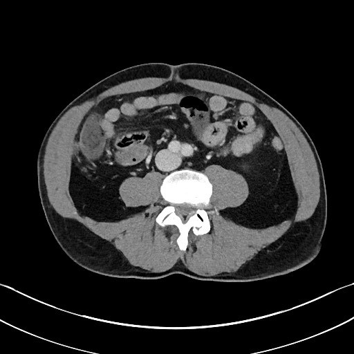 File:Closed loop small bowel obstruction - internal hernia (Radiopaedia 57806-64778 Axial 5).jpg